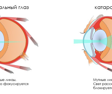 Катаракта