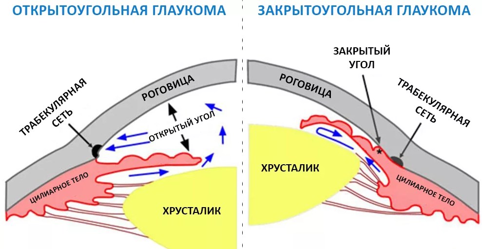 формы глаукомы