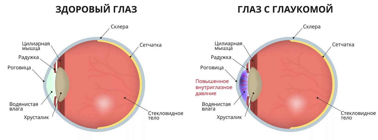 глаукома